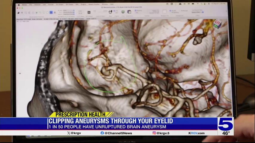 Prescription Health: New procedure treating brain aneurysms