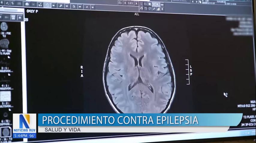 Nueva terapia celular experimental para epilepsia ofrece esperanza a millones de estadounidenses
