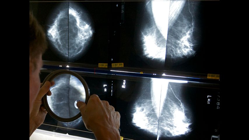 Cancer before age 50 is increasing. A new study looks at which types