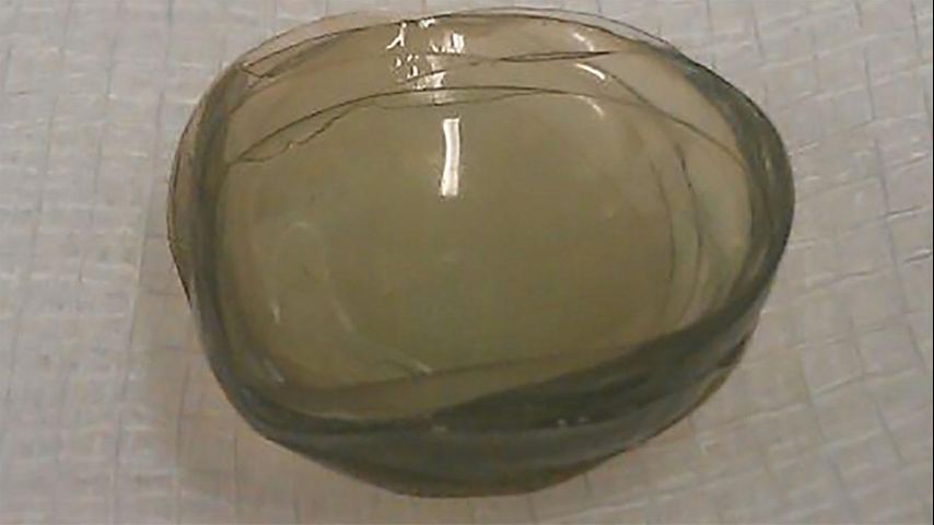 British doctors find 27 contact lenses in woman's eye