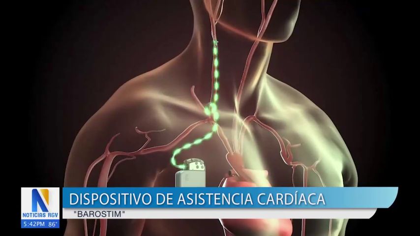 Salud y Vida: Dispositivo de asistencia cardiaca Barostim