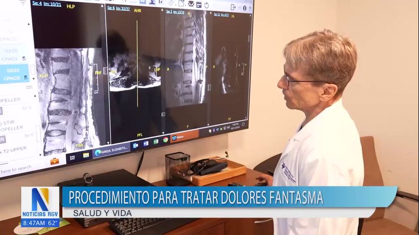 Procedimiento para tratar 'dolores fantasma'