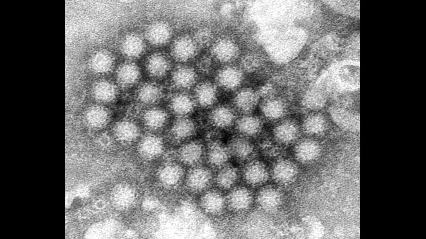 Nasty norovirus is back in full force with US cases of the stomach virus surging