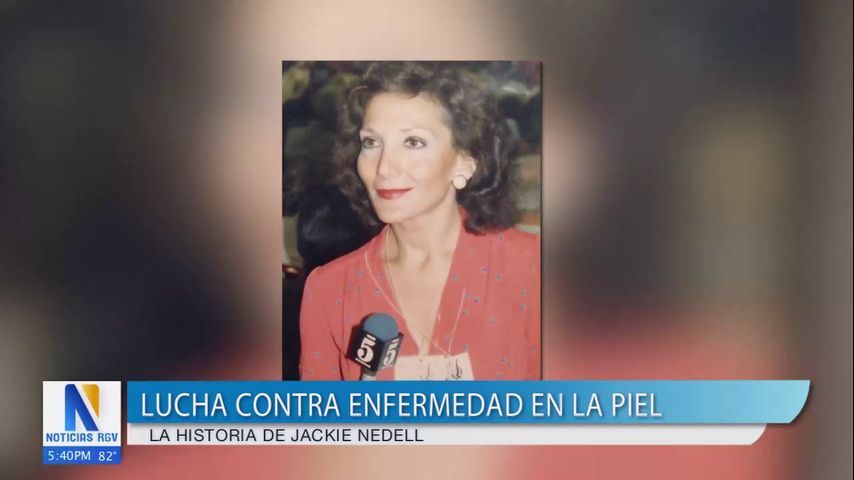 Salud y Vida: Periodista narra su historia de lucha contra una extraña enfermedad de la piel