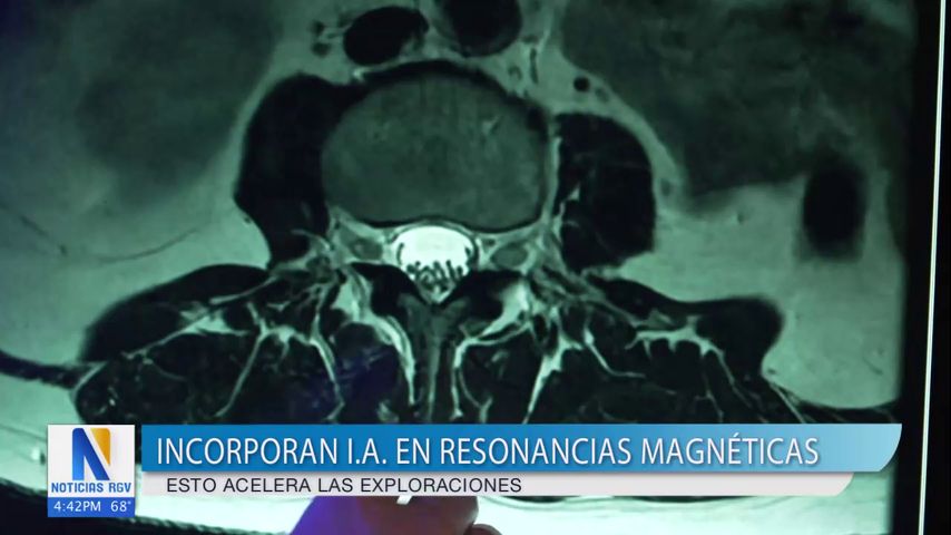 Salud y Vida: Inteligencia artificial logra mejorar las imágenes de resonancia magnética