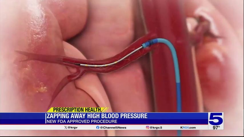 Prescription Health: New procedure zapping away high blood pressure