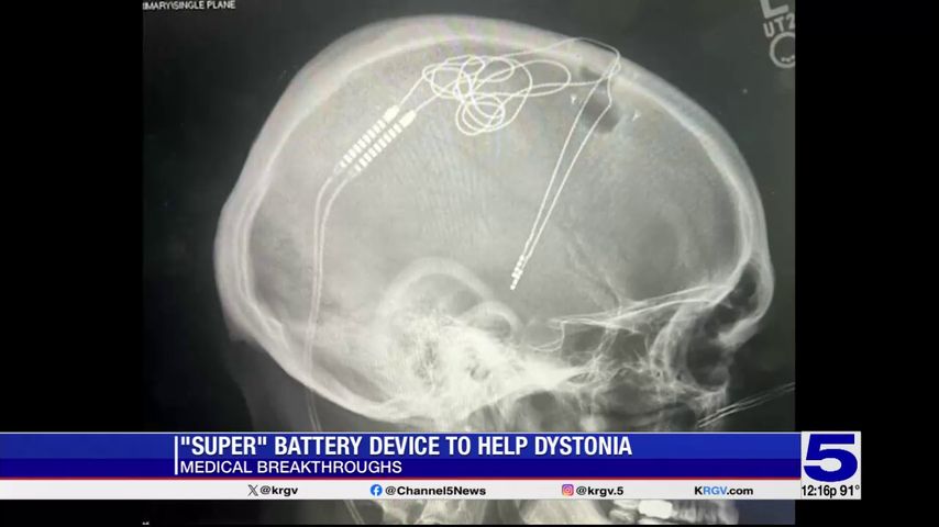 Medical Breakthroughs: New device helping patients diagnosed with dystonia