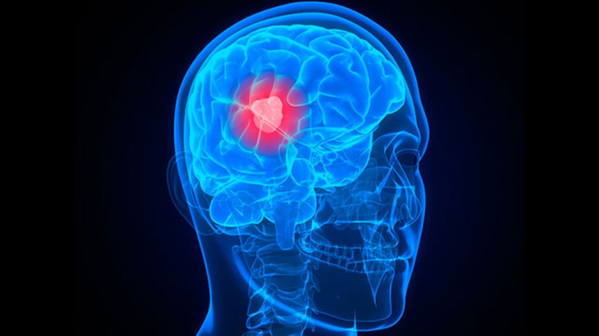 Doctors develop new way to test brain cancer drugs