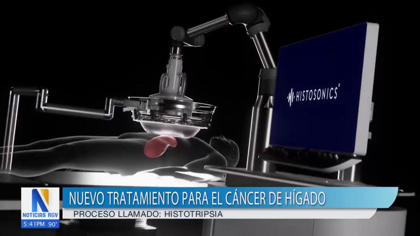 'Histotripsia', nuevo tratamiento para el cáncer de hígado