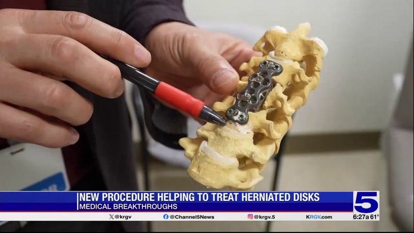 Medical Breakthroughs: New procedure helping to treat herniated disks