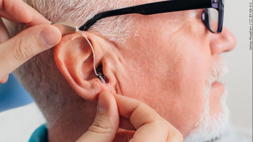 Read more about the article Severe hearing loss can lead to dementia, cochlear implants can help