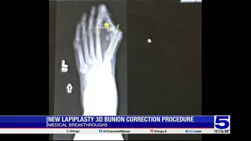 Medical Breakthroughs: New procedure treats the root cause of bunions