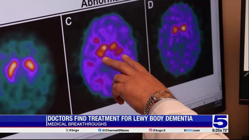 Medical Breakthroughs: Doctors find treatment for Lewy body dementia