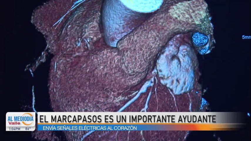 El marcapasos es crucial para enviar señales eléctricas al corazón