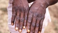 African scientists baffled by monkeypox cases in Europe, US