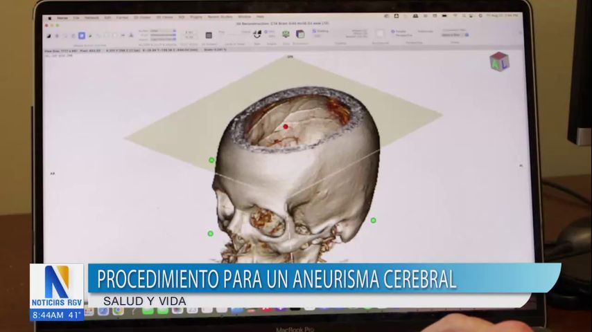 Procedimiento novedoso para un aneurisma cerebral