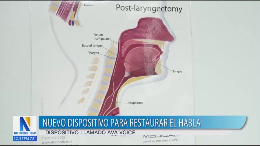 Utilizan nuevo dispositivo en pacientes que necesitan recuperar el habla