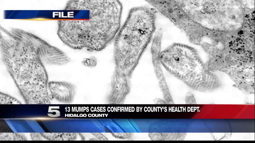 Mumps Cases Increasing: 14 Confirmed Cases