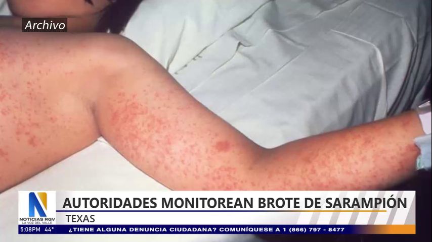 Autoridades de Texas monitorean brote de sarampión