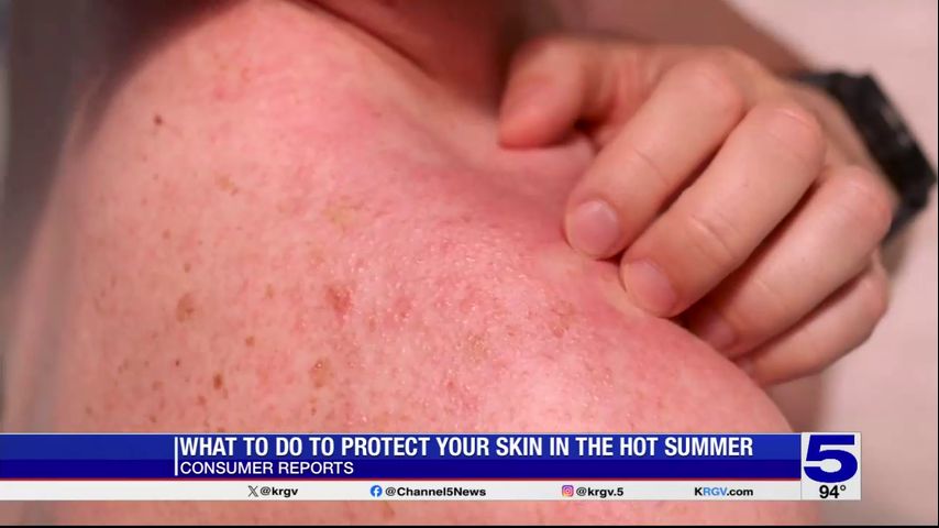 Consumer Reports: Sunburn care and prevention