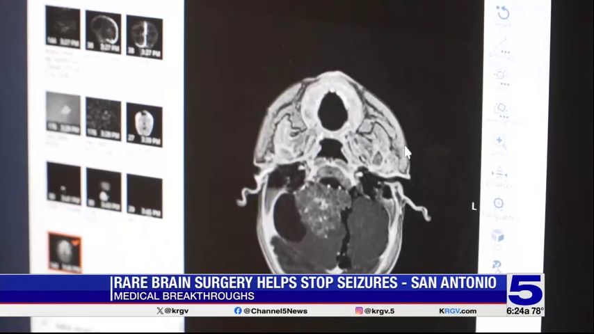 Medical Breakthroughs: Rare brain surgery helps stop seizures