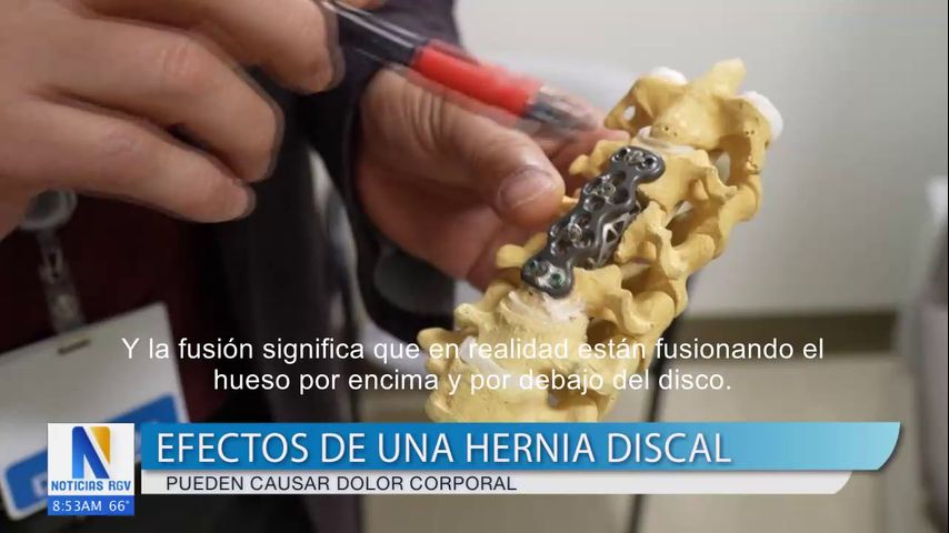 Advierten sobre los efectos de no detectar una hernia discal