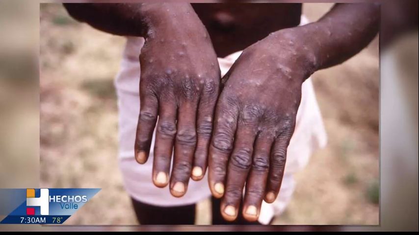 Investigan casos de viruela del simio en Estados Unidos