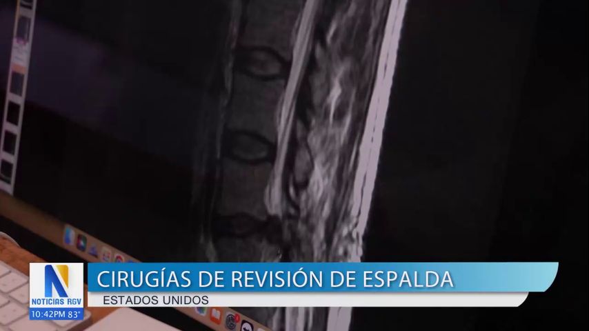 Salud y Vida: Aumentan los casos de síndrome de espalda fallida en EE.UU.