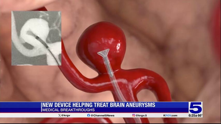 Medical Breakthroughs: New device helping treat brain aneurysms