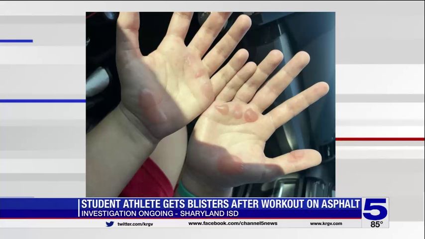 Sharyland ISD investigates after student athlete gets hand blisters from workout on hot asphalt