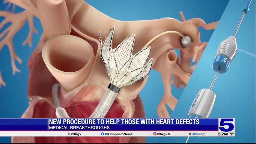 Medical Breakthroughs: New procedure to help those with heart defects